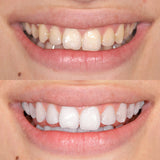 GLO Brilliant Teeth Whitening Device