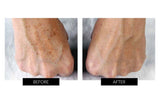 Trophy Skin MiniMD Handheld Microdermabrasion Device