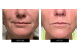 Trophy Skin MiniMD Handheld Microdermabrasion Device