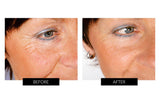 Trophy Skin MicrodermMD Home Microdermabrasion System