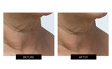 Trophy Skin MiniMD Handheld Microdermabrasion Device