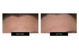 Trophy Skin MiniMD Handheld Microdermabrasion Device
