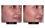 Trophy Skin MiniMD Handheld Microdermabrasion Device